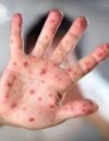 Вспышка кори в Украине: рекомендации Минздрава, как предотвратить заболевание (инфографика)